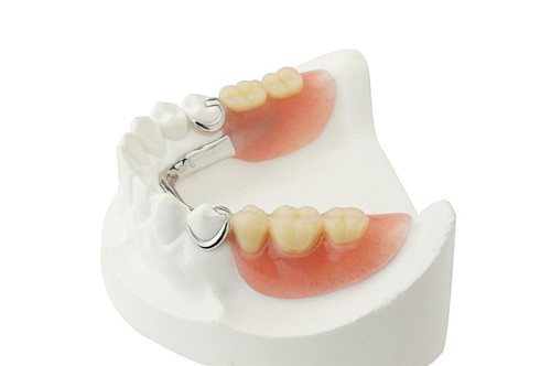 入れ歯・義歯のイメージ図
