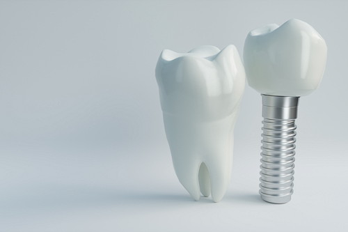 通常の歯とインプラントした歯の模型