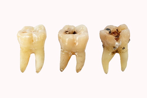 正常な歯と虫歯