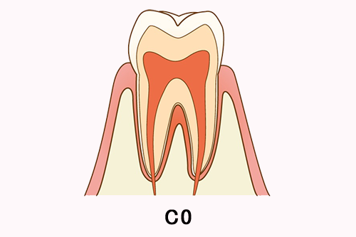 要観察歯の断面図