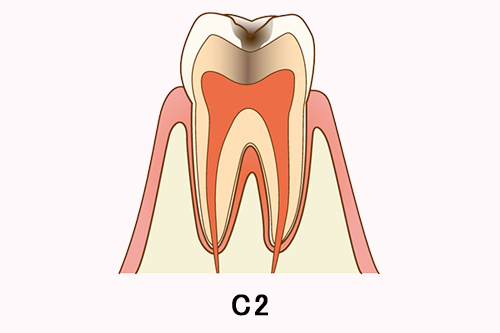 歯の内部まで進行した虫歯の断面図