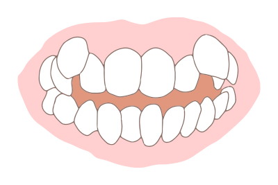 八重歯の目立つ歯並びのイラスト
