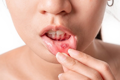 口内炎を確認する女性