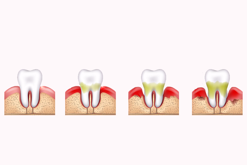 歯周病の進行度合いのイメージ図
