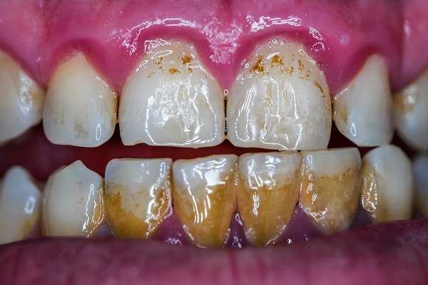 磨き残しの多い歯