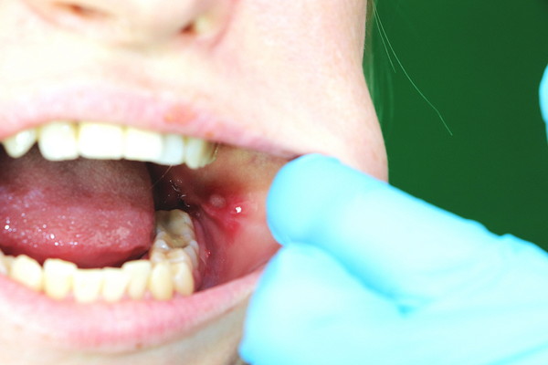 歯科医院での口内炎の確認の様子