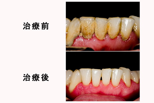 歯石を除去する前と後