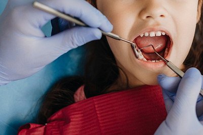 子どもの歯を治療する様子