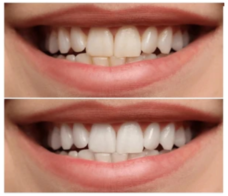 歯の着色汚れ（ステイン）が気になる方へ｜原因と柏などがや歯科クリニックでのクリーニング・ホワイトニングの効果を解説 画像